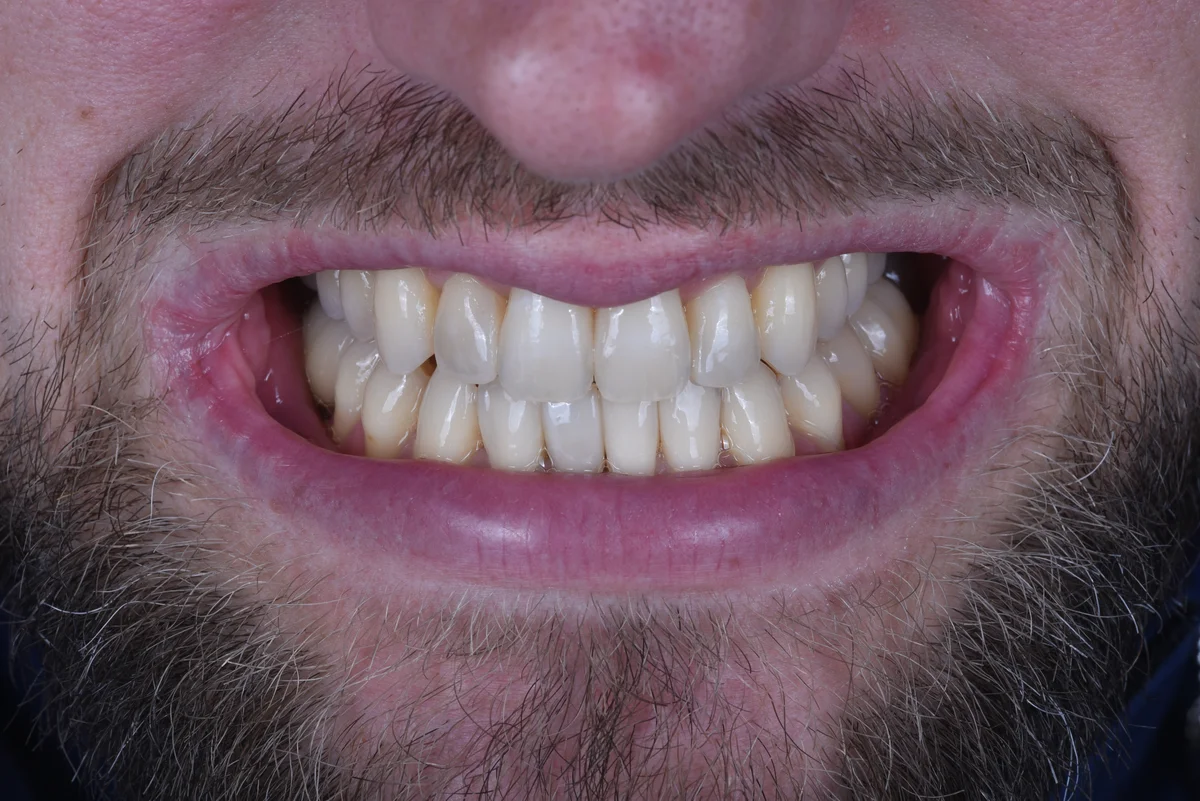 Aesthetic Fillings — Small lateral teeth
