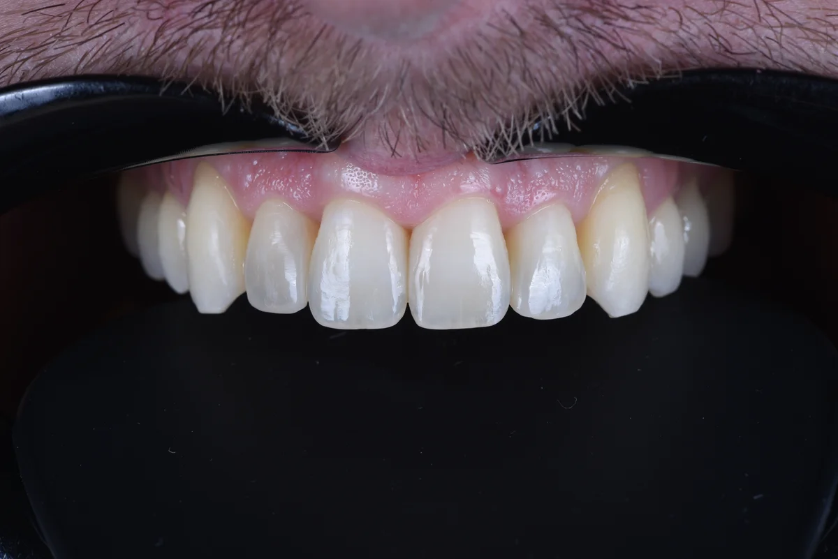 After — Small lateral teeth