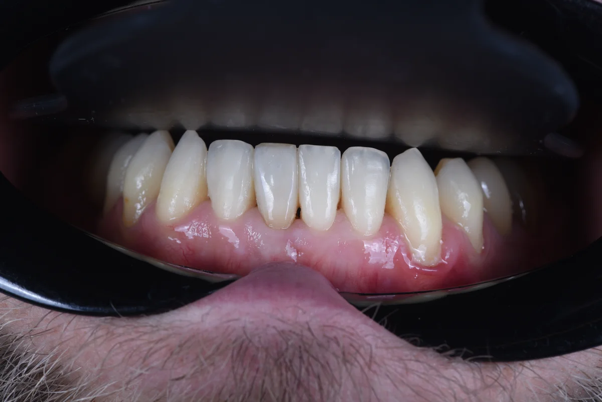 After — Small lateral teeth