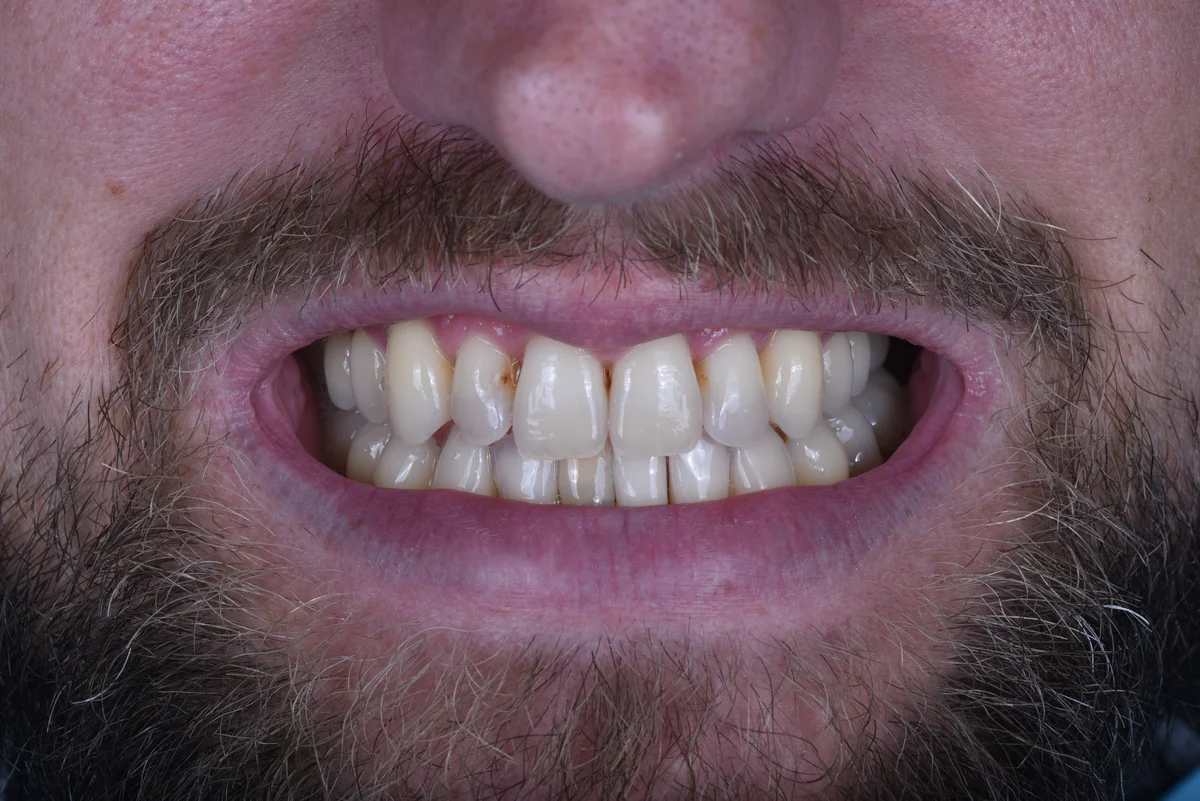 Before — Small lateral teeth