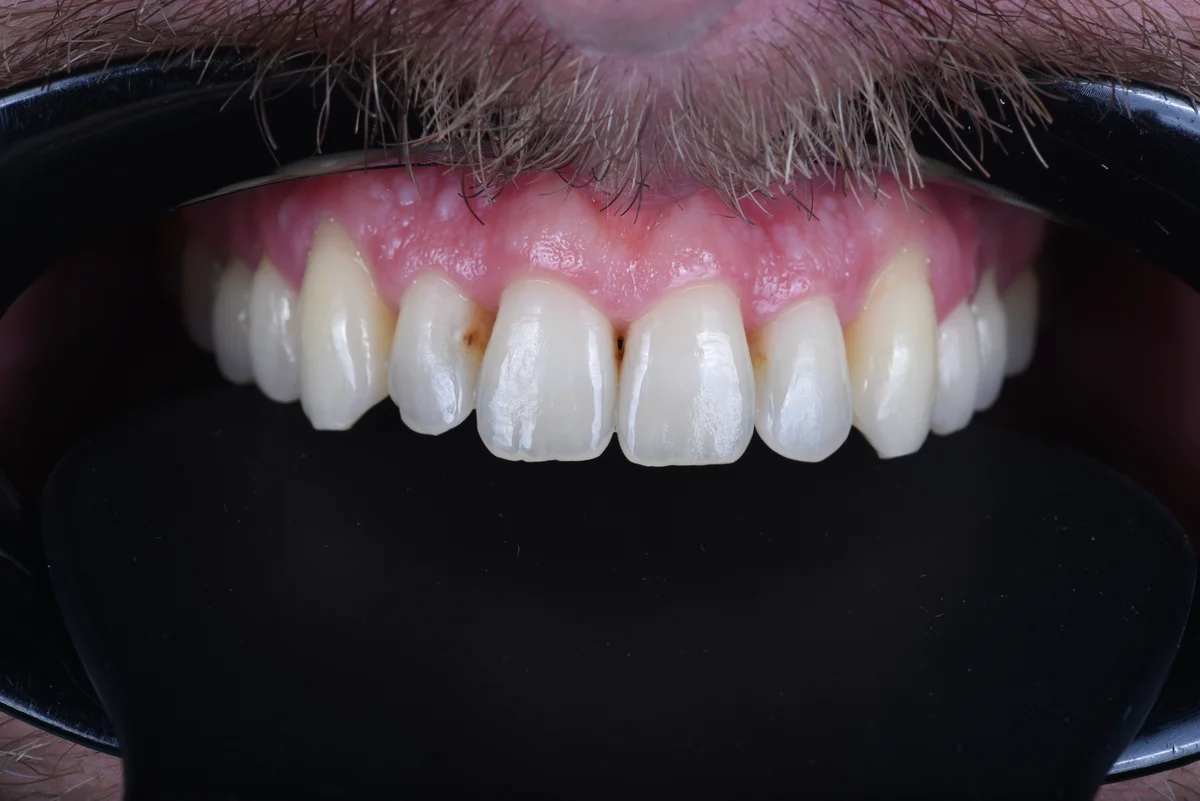 Before — Small lateral teeth