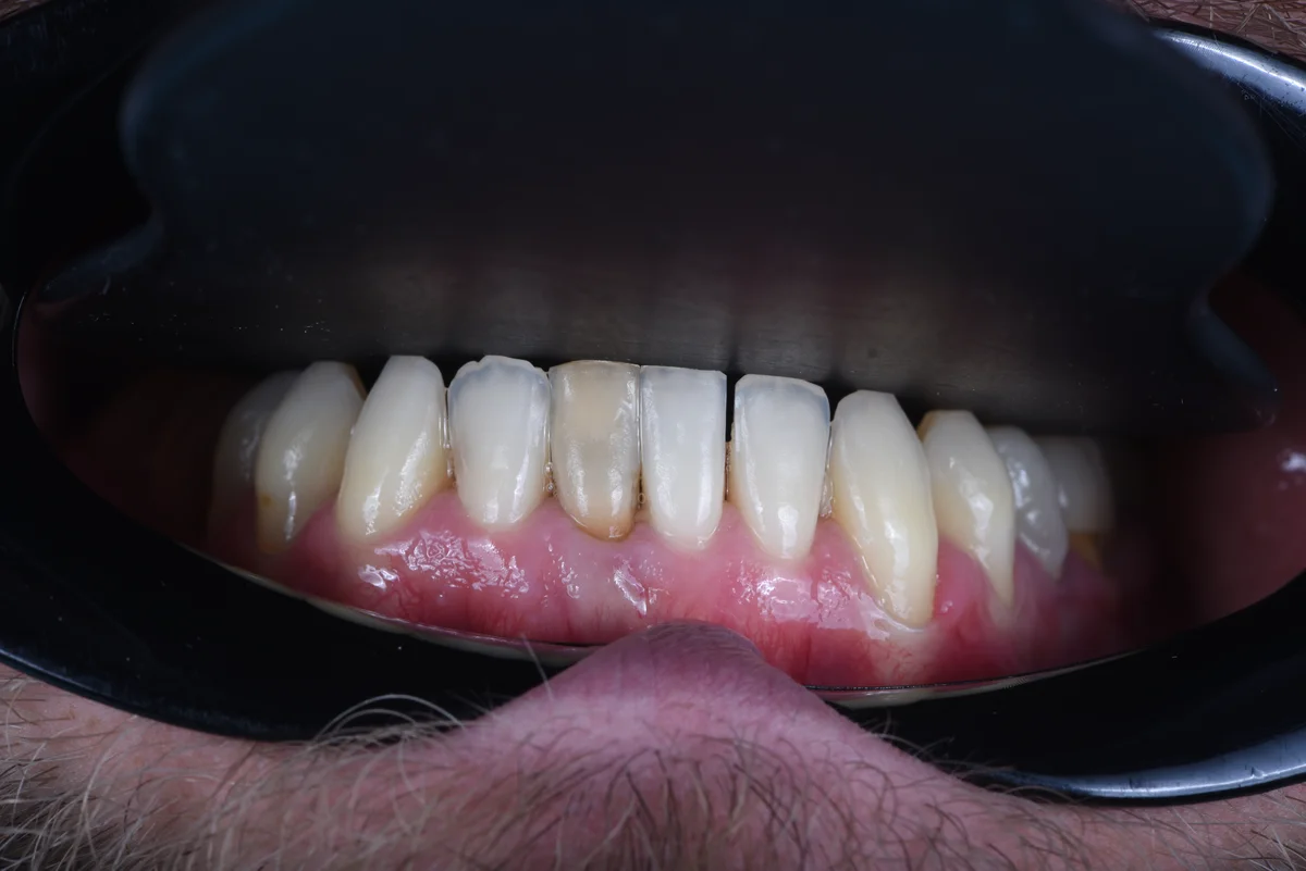 Before — Small lateral teeth