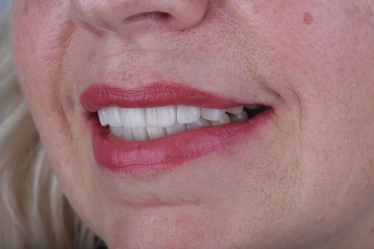Aesthetic Fillings — Smile asymmetry