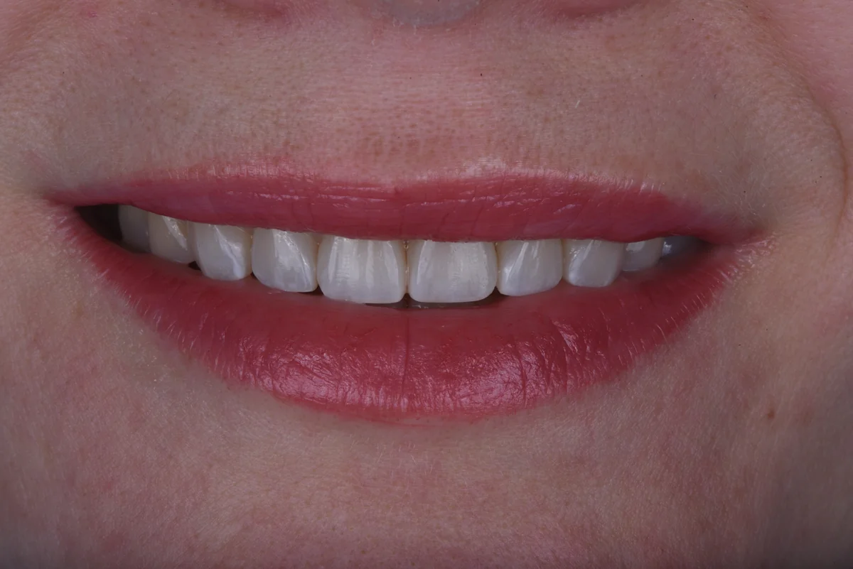 Aesthetic Fillings — Bruxism
