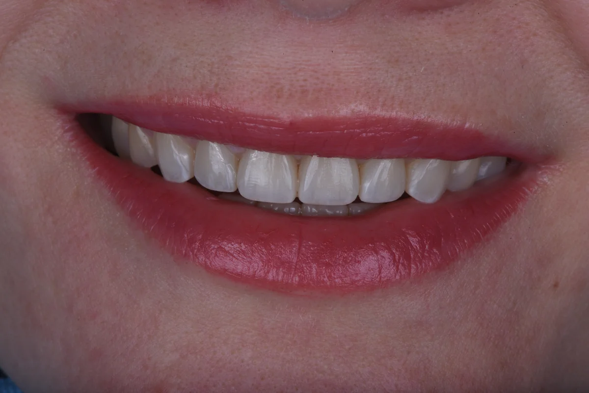 After — Bruxism