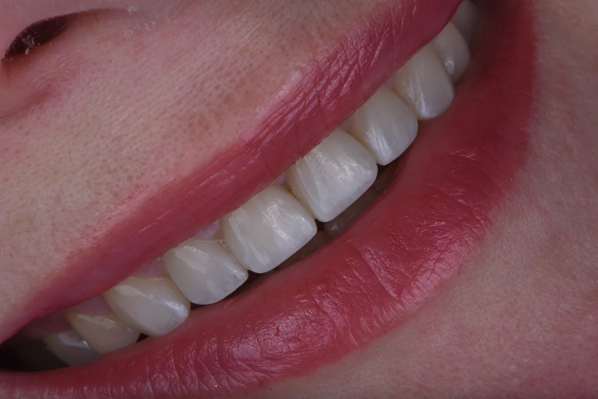 After — Bruxism