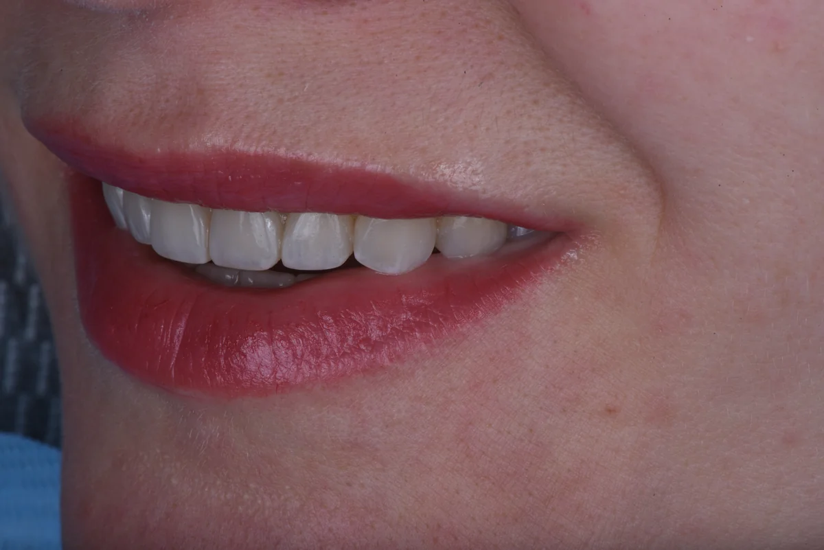 After — Bruxism