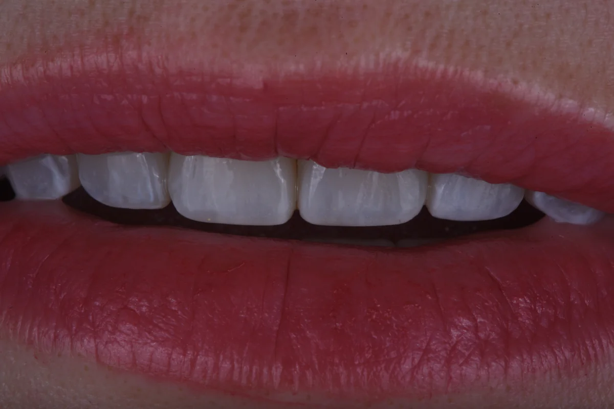 After — Bruxism