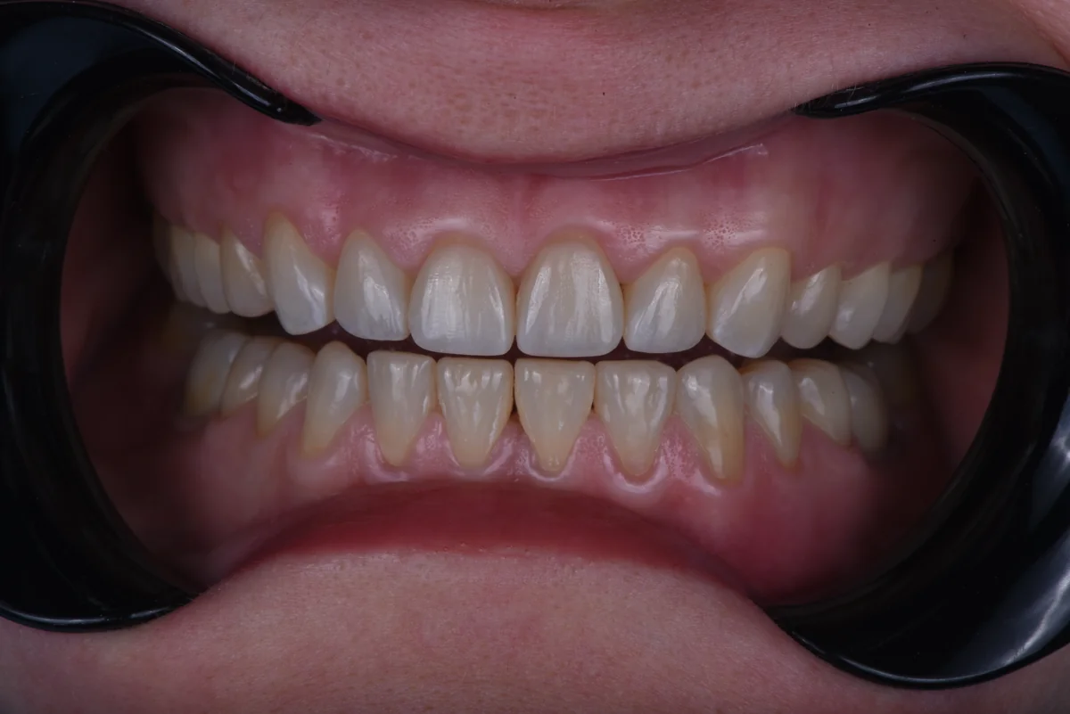 After — Bruxism