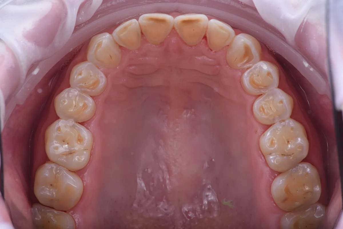 Before — Bruxism