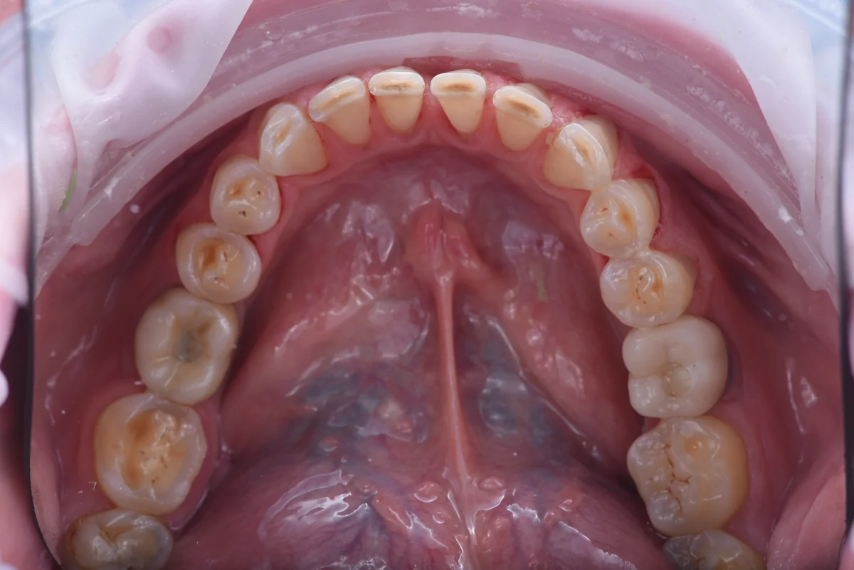 Before — Bruxism
