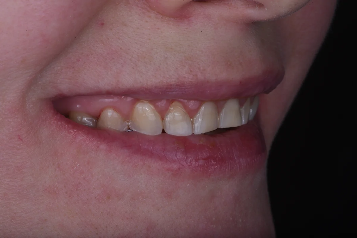 Before — Bruxism