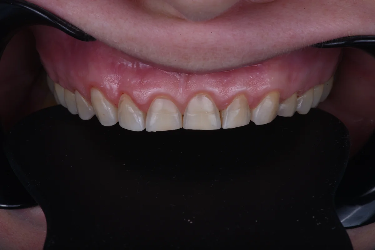 Before — Bruxism