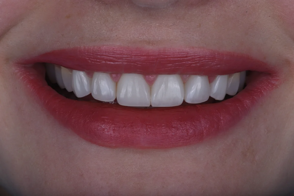 Aesthetic Fillings — Bruxism II
