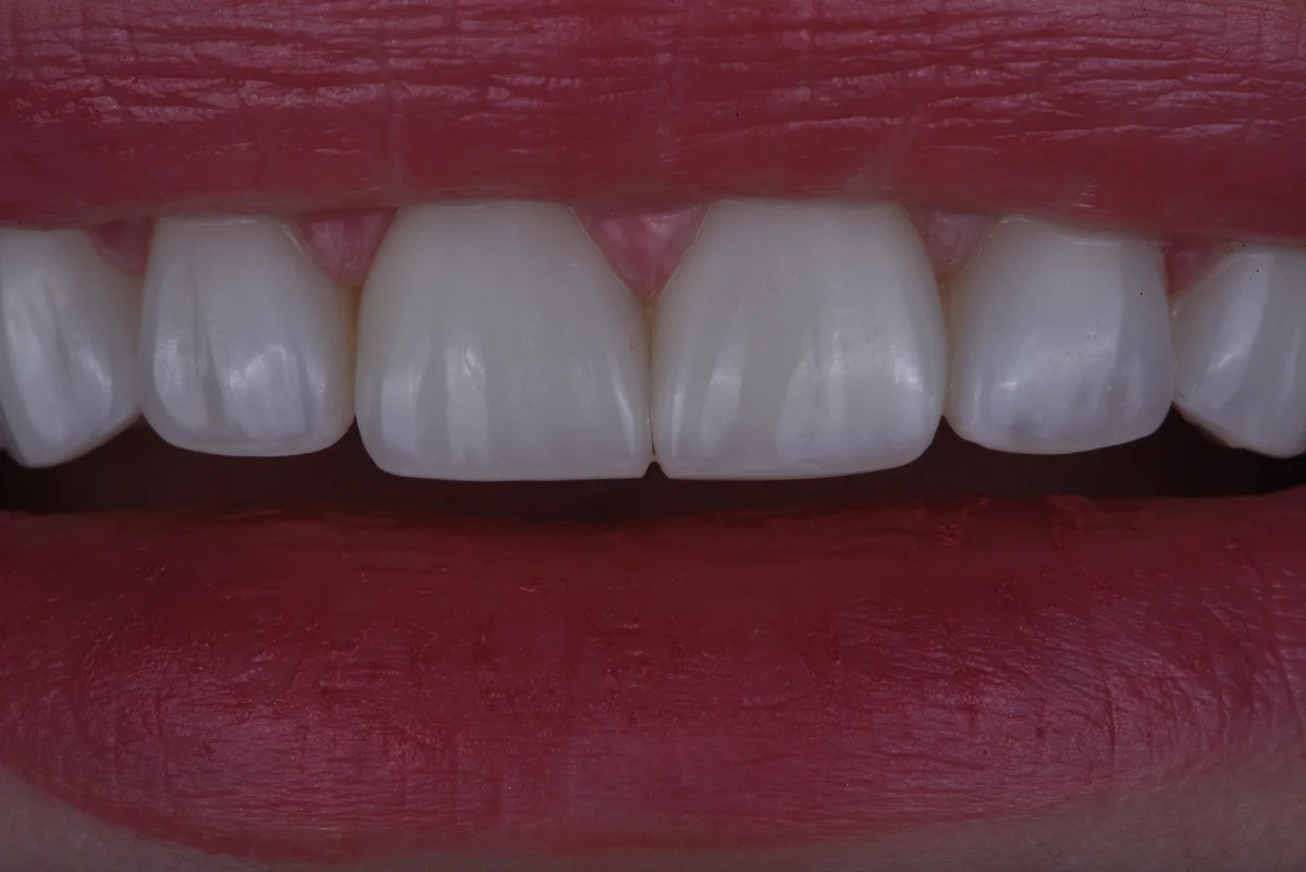 After — Bruxism II