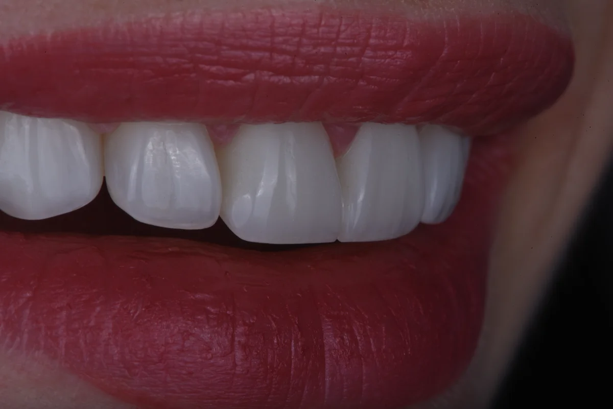 After — Bruxism II