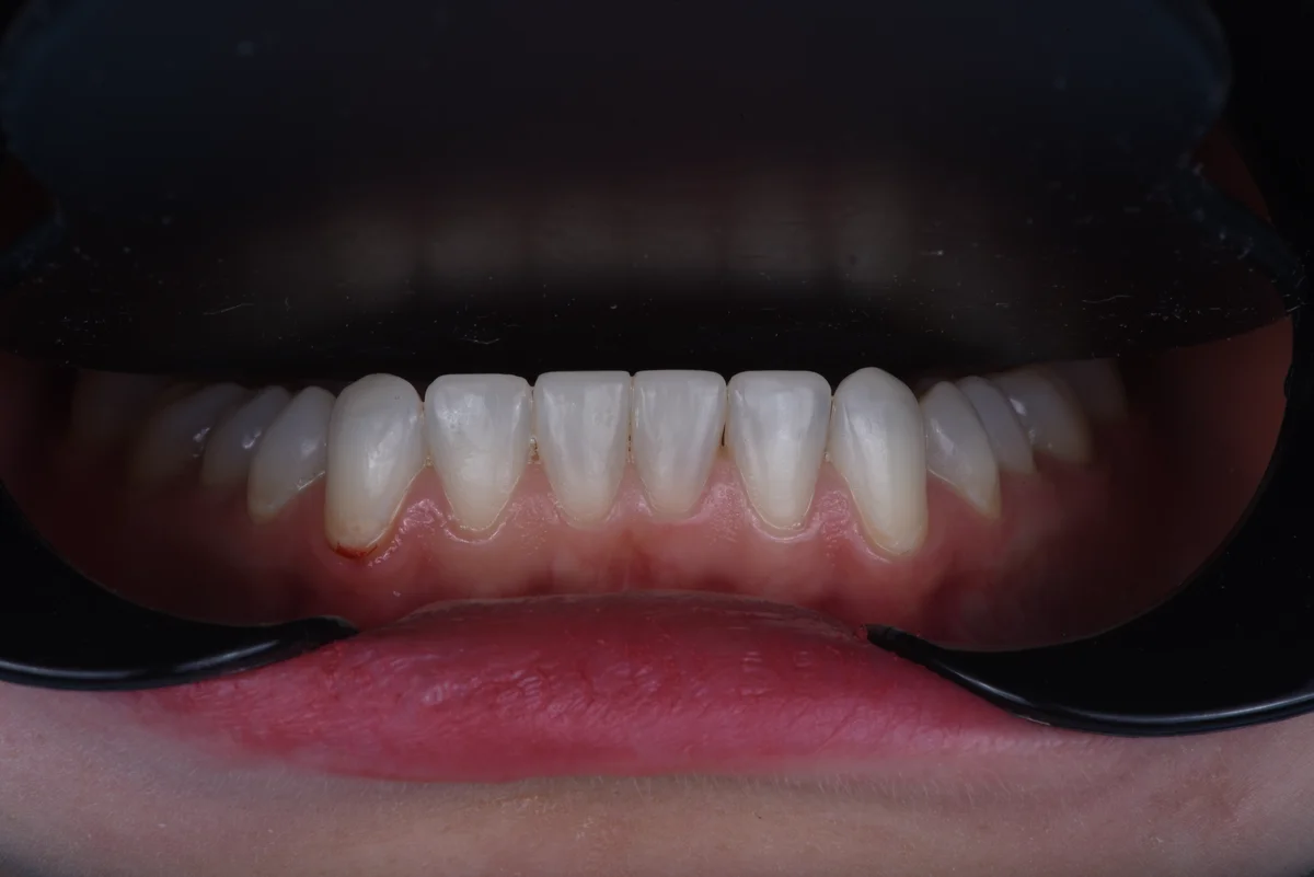 After — Bruxism II