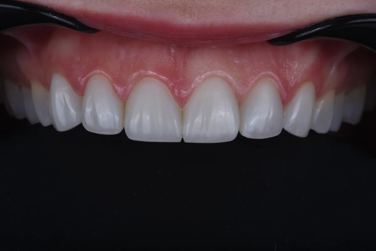 After — Bruxism II