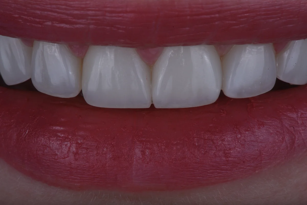 After — Bruxism II