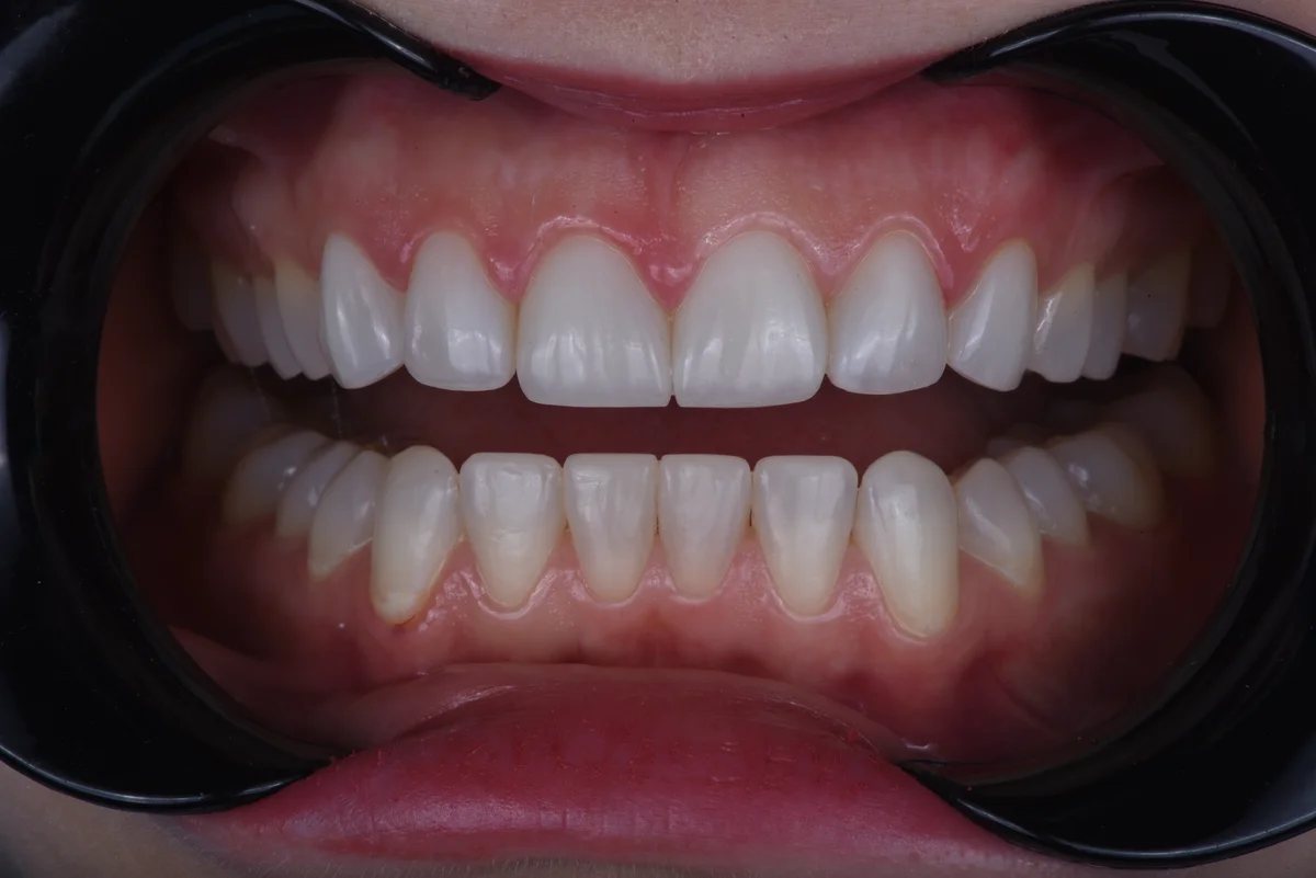 After — Bruxism II