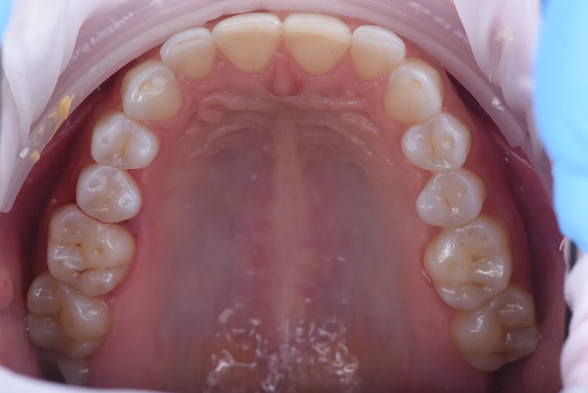 Before — Bruxism II