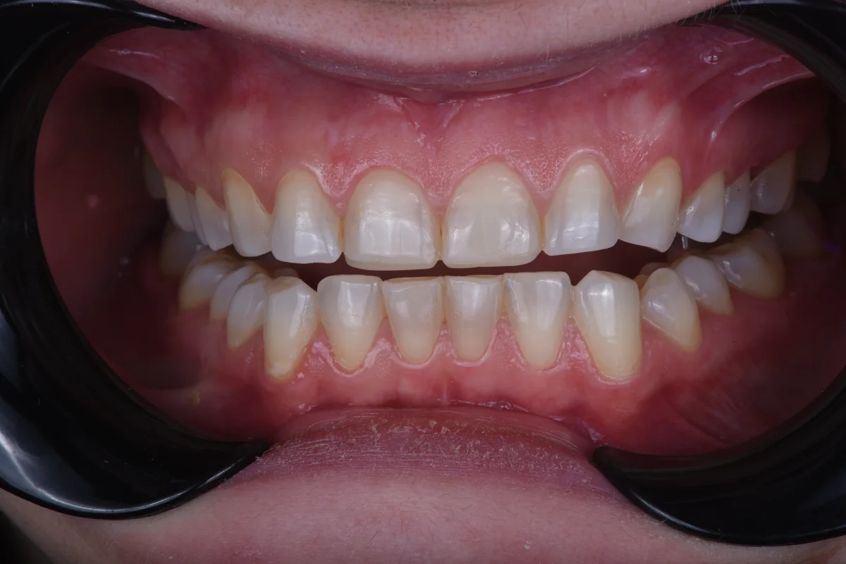 Before — Bruxism II