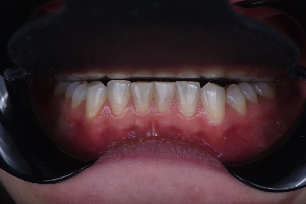 Before — Bruxism II