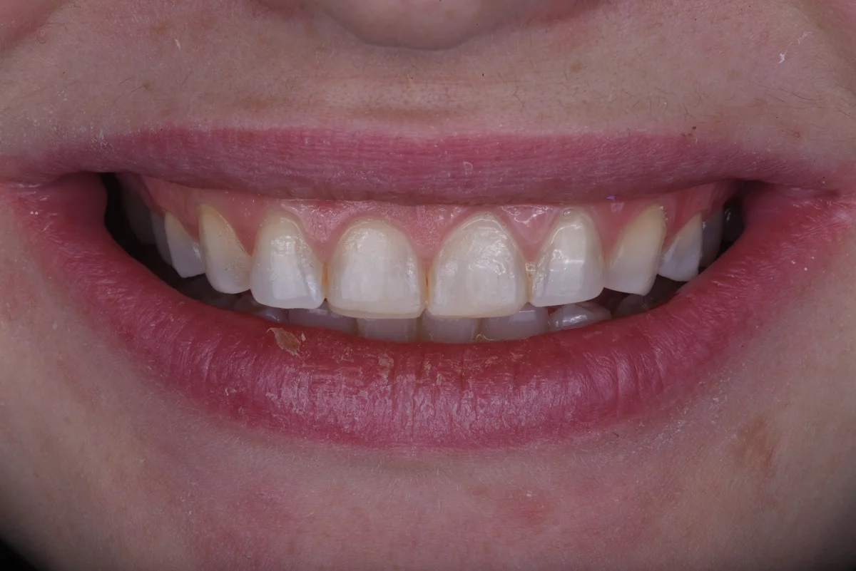 Before — Bruxism II