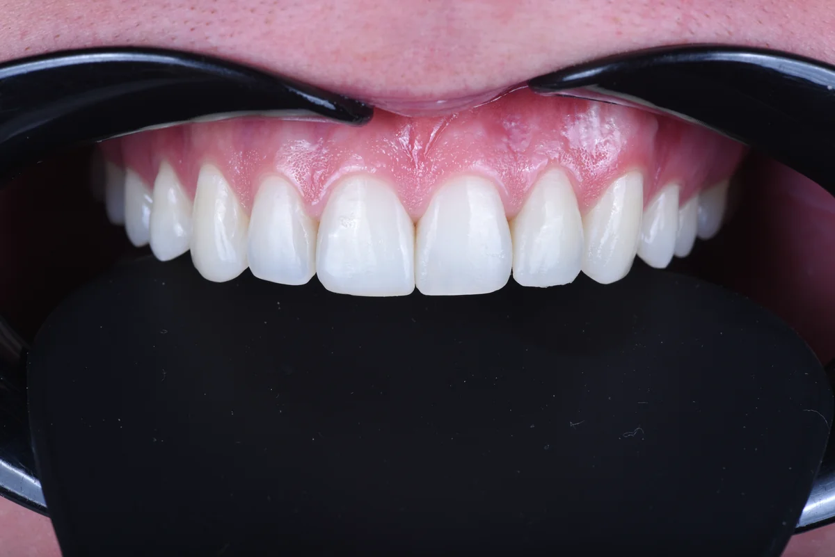After — Black triangles