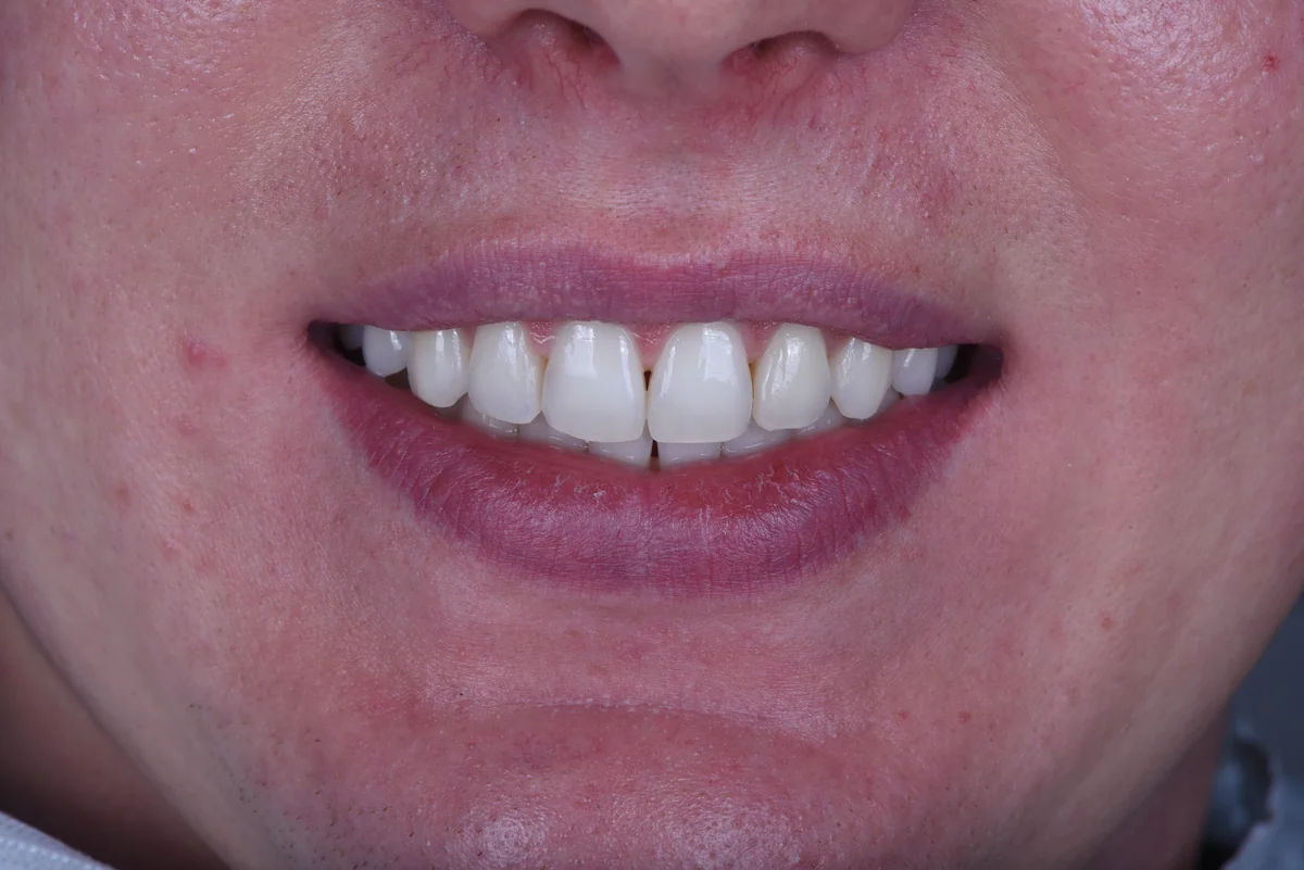Before — Black triangles