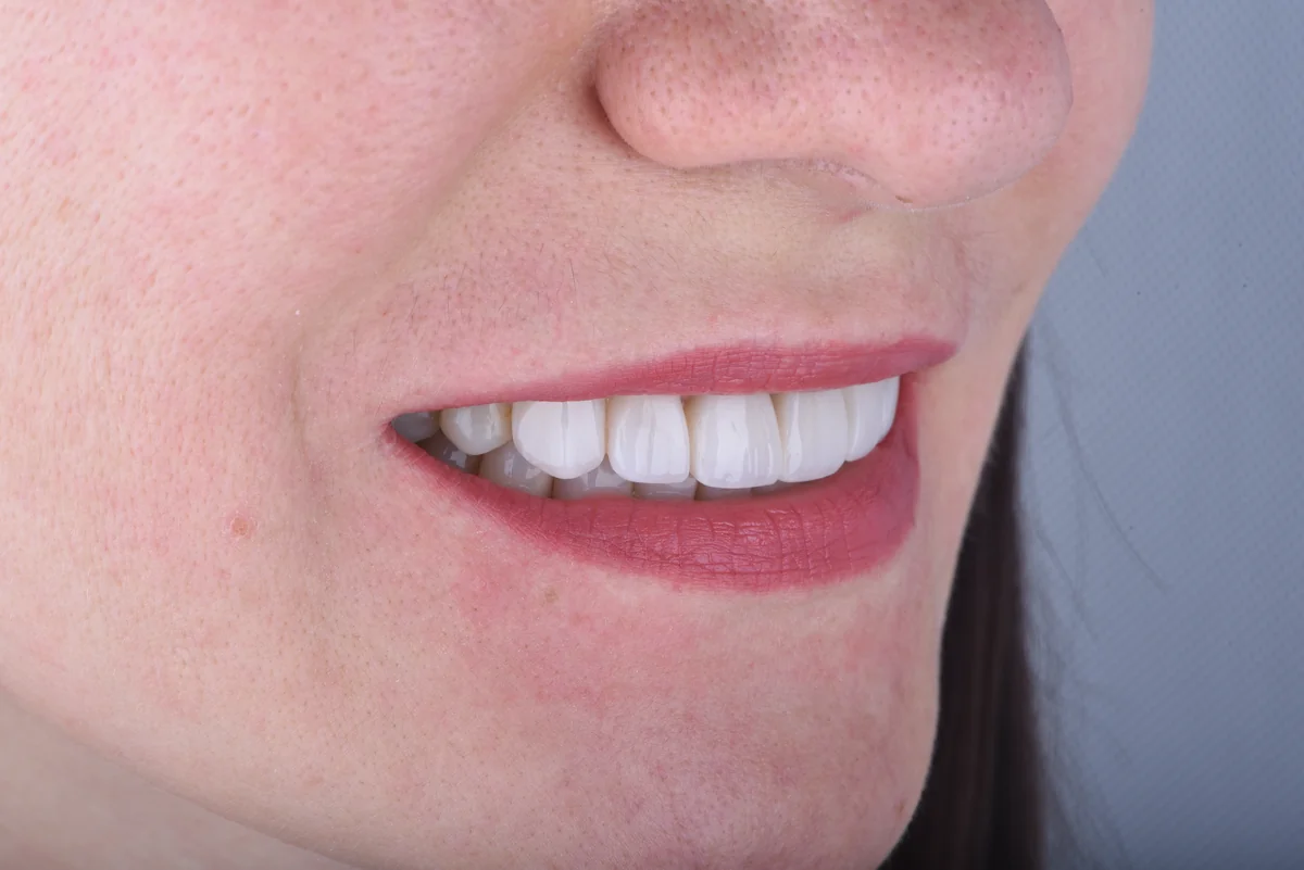 Aesthetic Fillings — Darkened front tooth