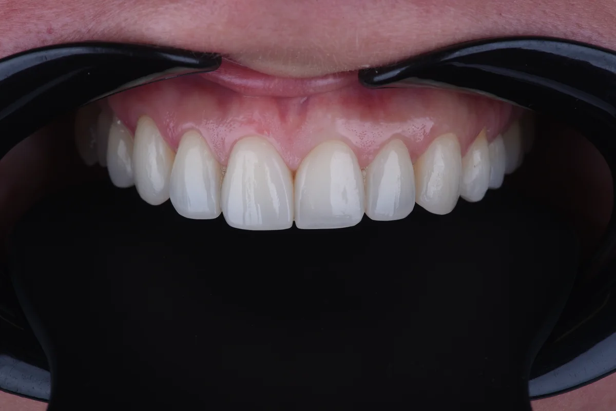 Aesthetic Fillings — Worn incisal edges