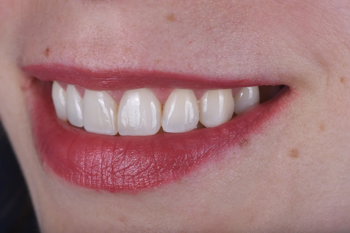 Aesthetic Fillings — After orthodontic treatment