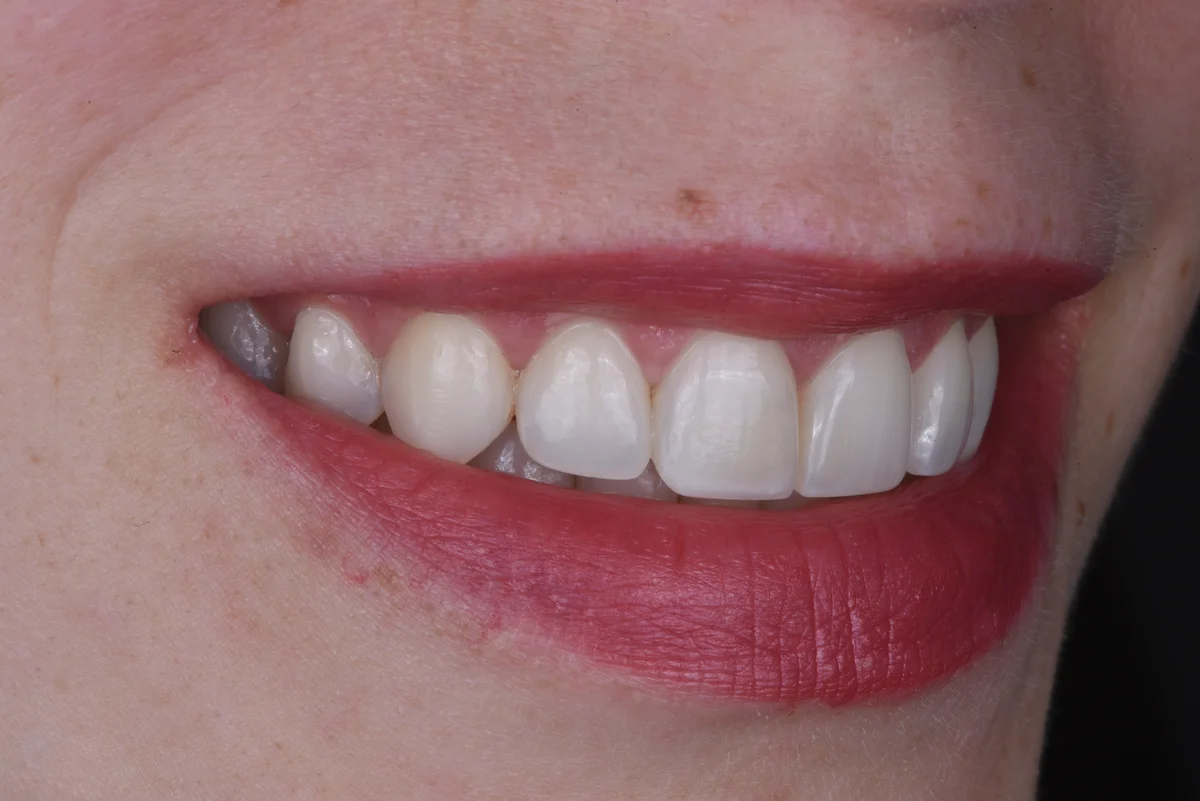 After — After orthodontic treatment