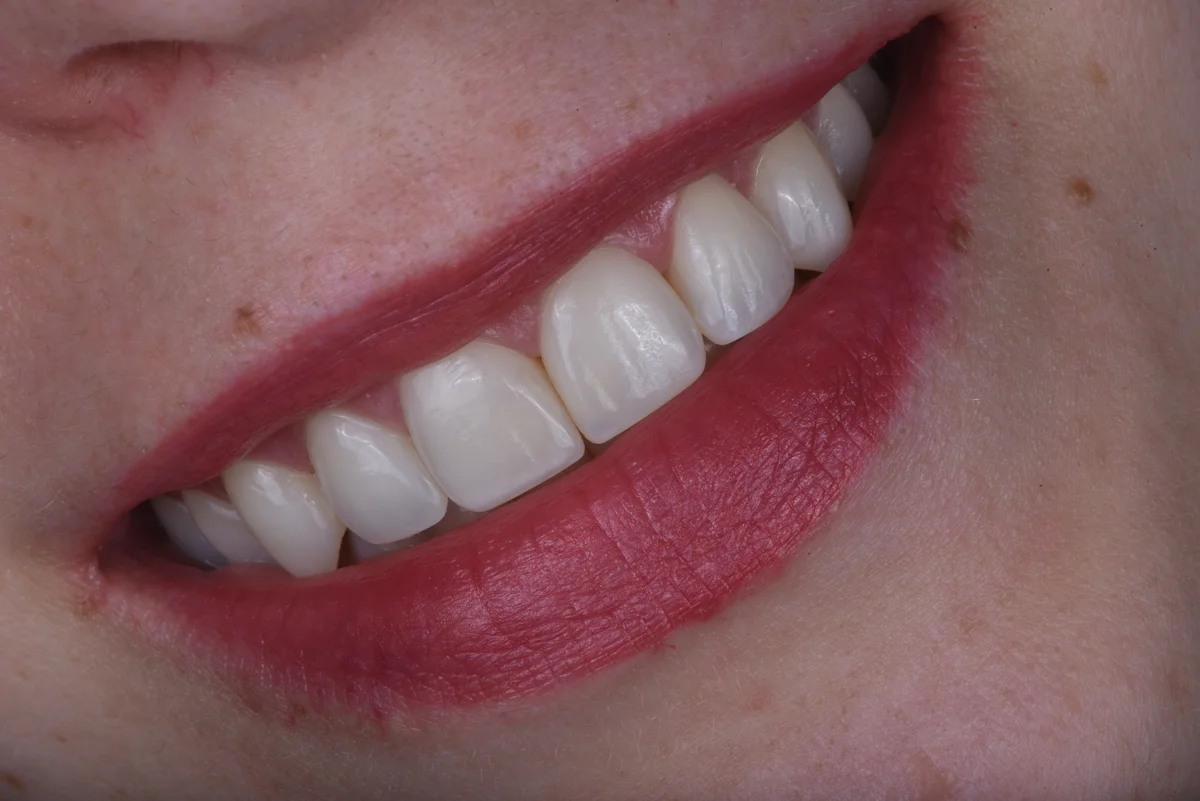 After — After orthodontic treatment