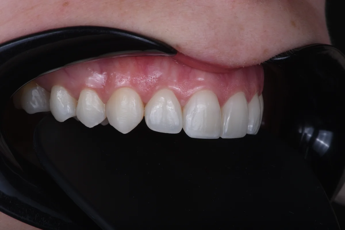 After — After orthodontic treatment
