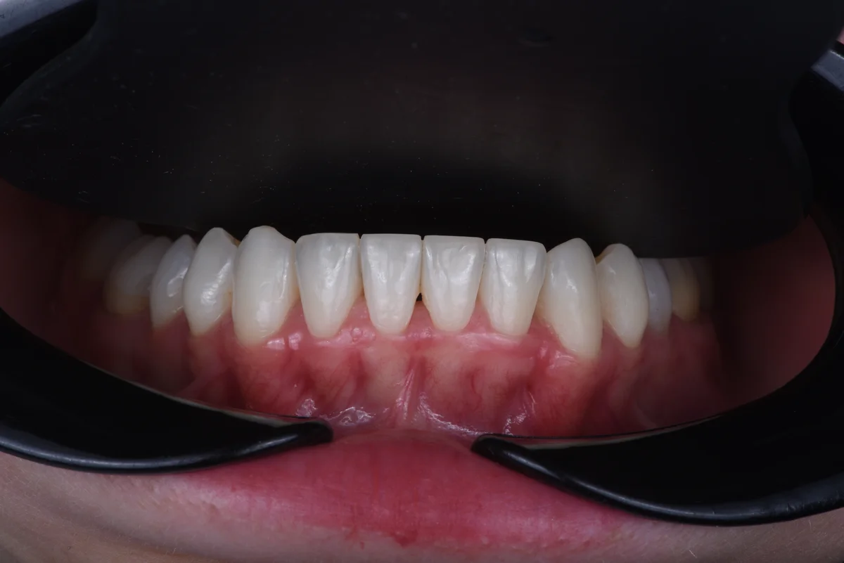 After — After orthodontic treatment