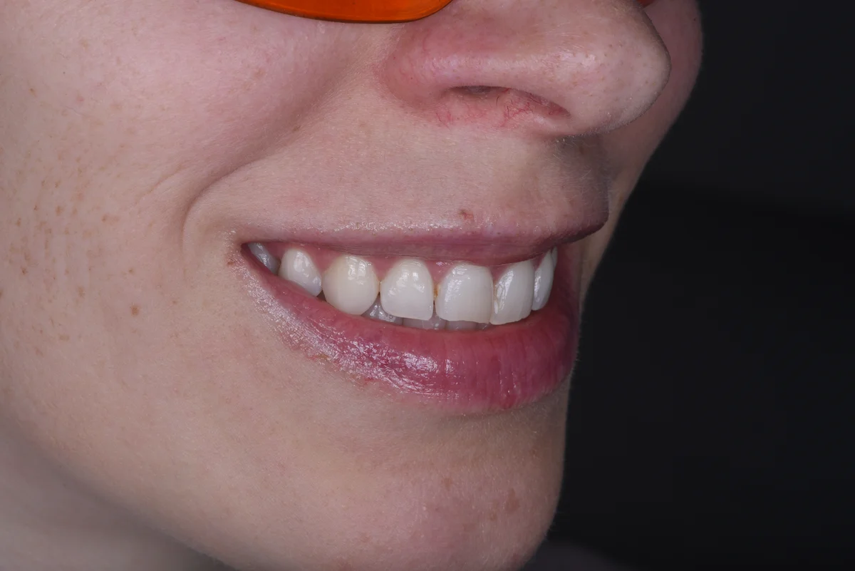Before — After orthodontic treatment