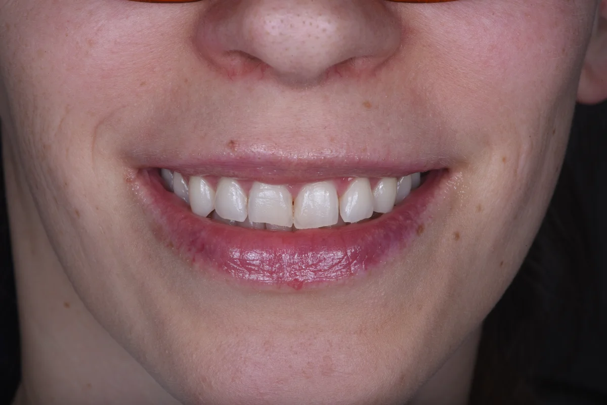 Before — After orthodontic treatment