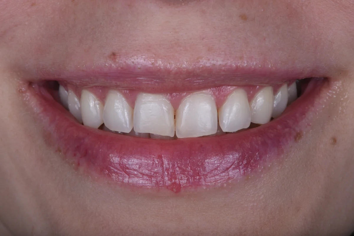 Before — After orthodontic treatment