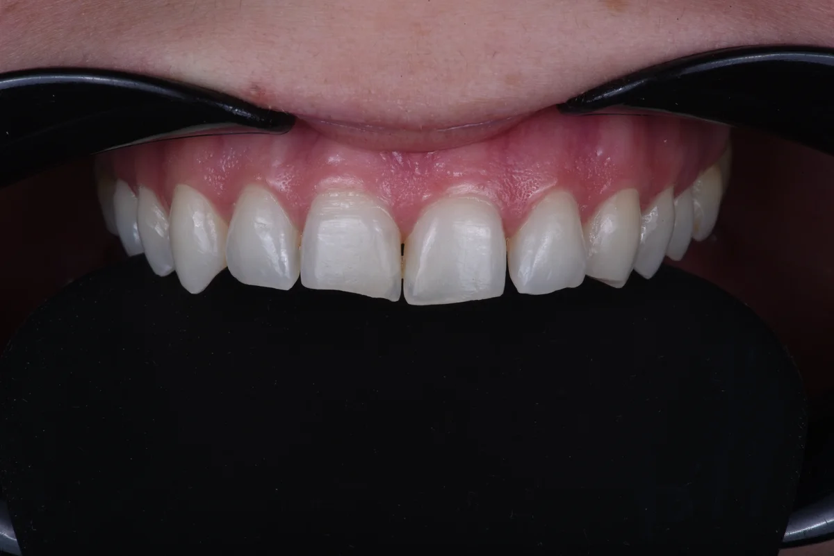 Before — After orthodontic treatment