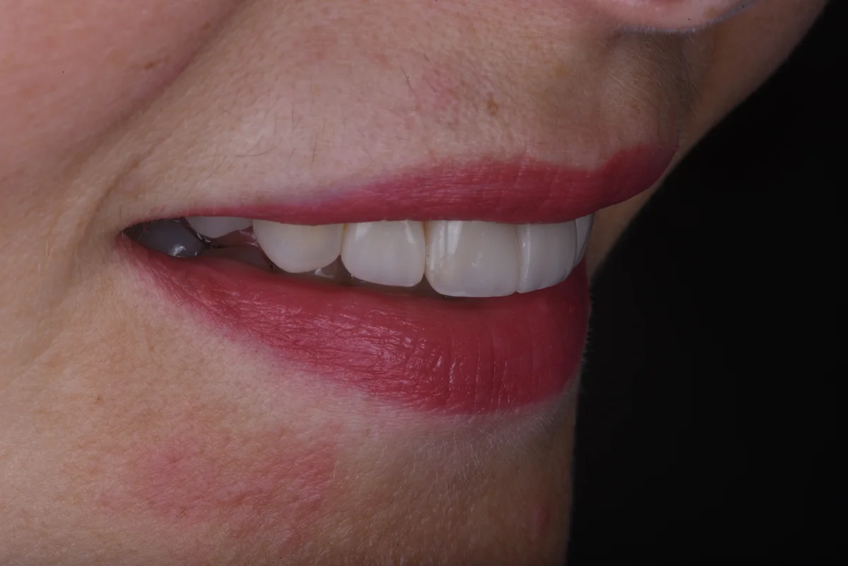 Aesthetic Fillings — Replacing old fillings