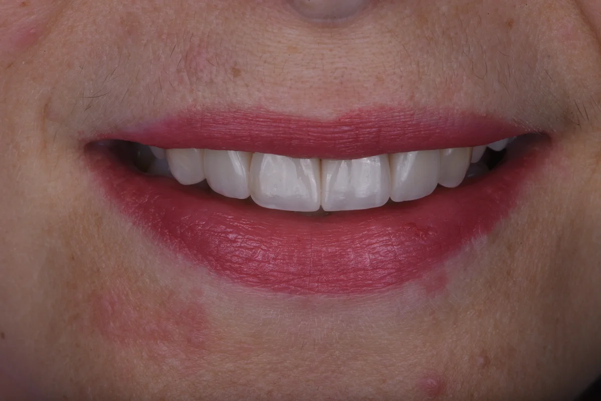 After — Replacing old fillings