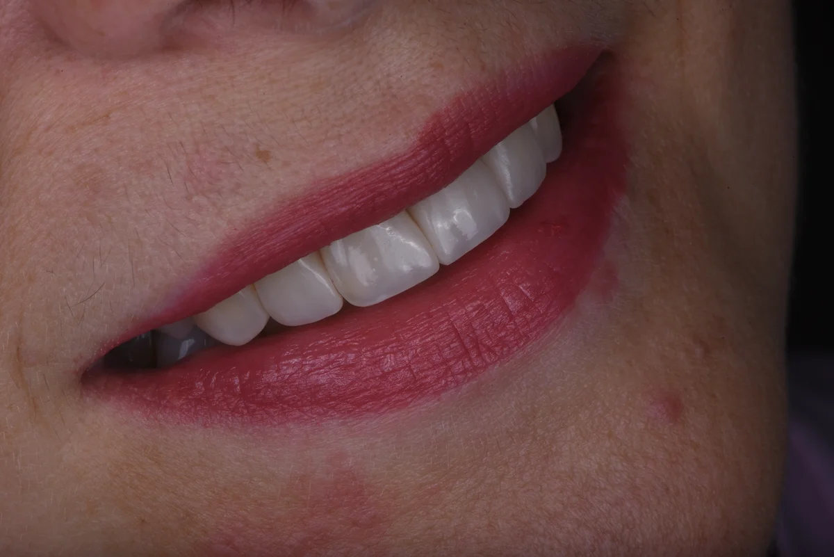 After — Replacing old fillings