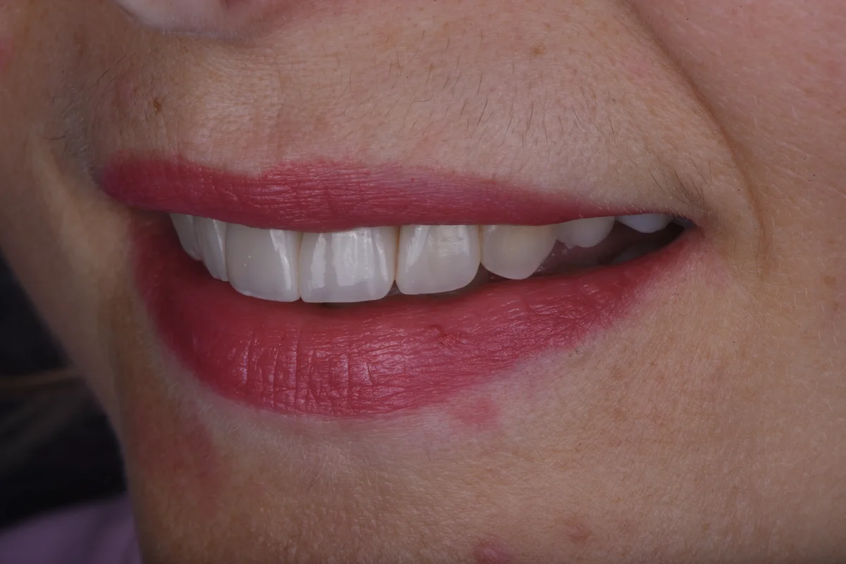 After — Replacing old fillings