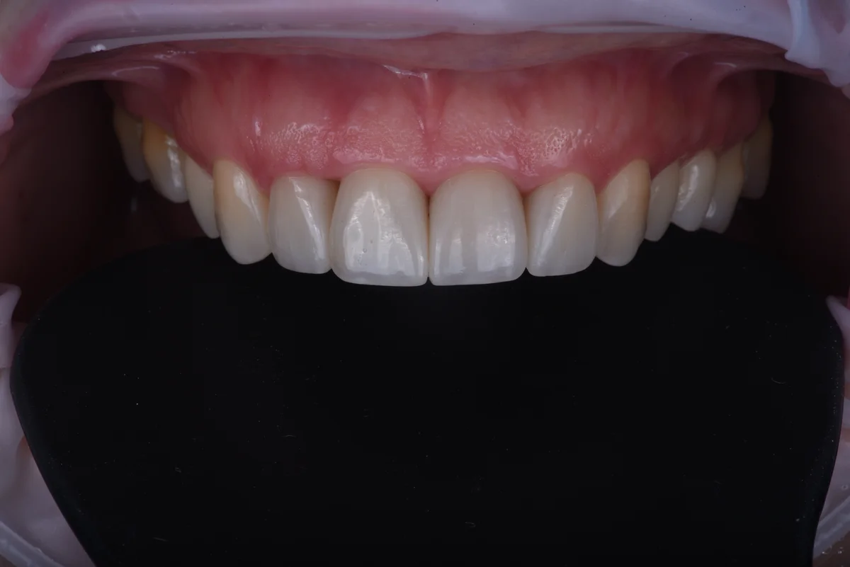 After — Replacing old fillings