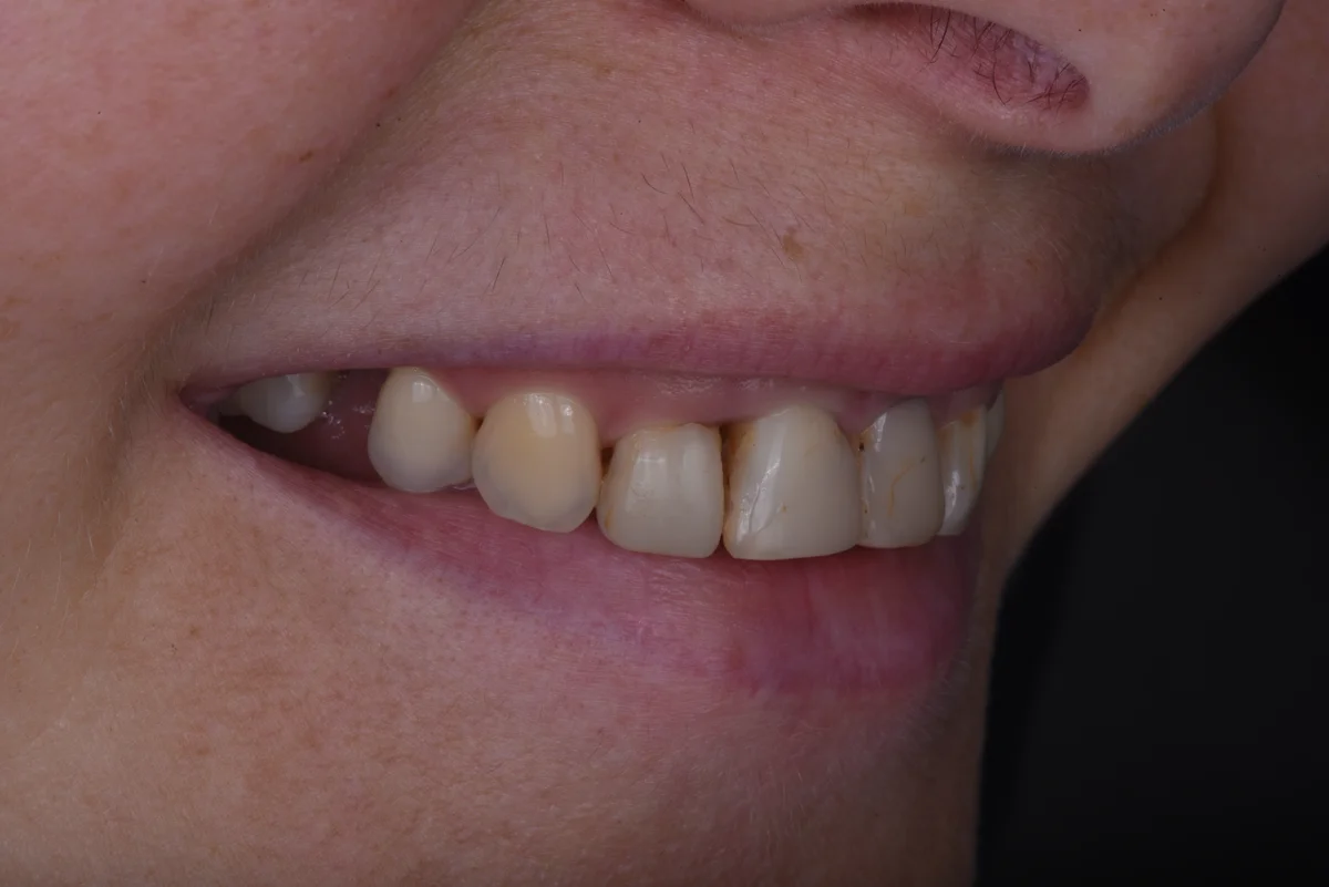 Before — Replacing old fillings