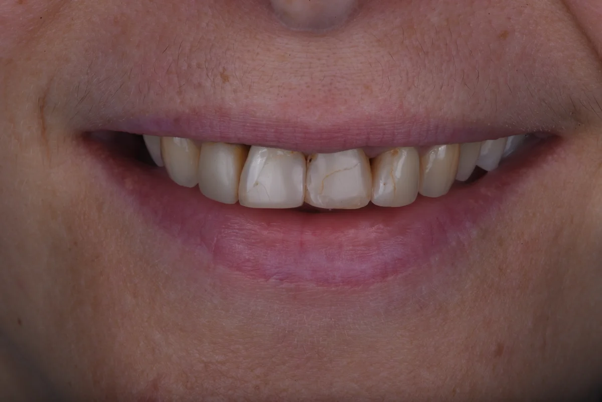 Before — Replacing old fillings