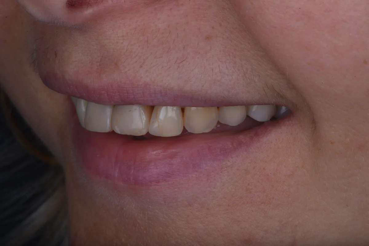 Before — Replacing old fillings