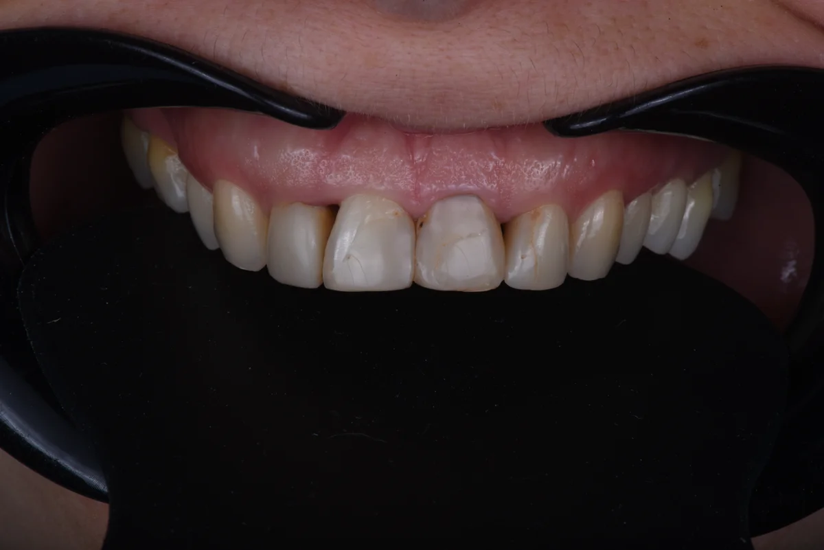 Before — Replacing old fillings